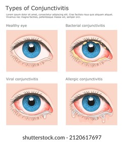 Three types of conjunctivitis and healthy eye medical vector illustration.