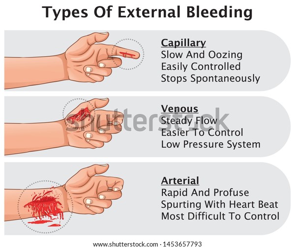 Three Types Of External Bleeding Hemorrhage\
Classification Capillary Venous And Arterial And Definition Medical\
Education Vector\
illustration