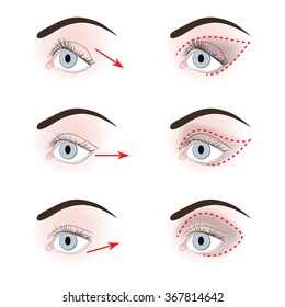 Three types of eyelids: down turned, up turned, almond