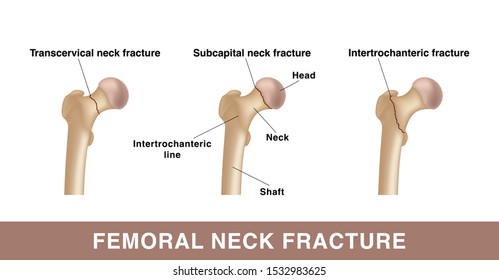 Three types of femoral neck fracture. Realistic drawing showing broken bone with inscriptions isolated on whie background.