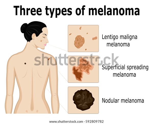 Three Types Melanoma That Example Located Stock Vector (Royalty Free ...