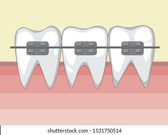 Three white molars with braces. Healthy teeth after visiting the orthodontist