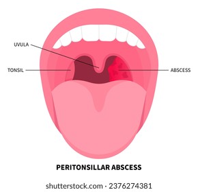 Throat abscess swelling of tonsil gland that cause by bacterial infection with medical examination