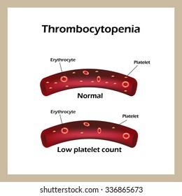 Thrombozytopenie Bilder Stockfotos Und Vektorgrafiken Shutterstock