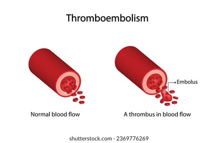 Thromboembolism. Circulating blood clot. Normal blood flow and a thrombus in blood flow, embolus. Red blood cell. Vector illustration.