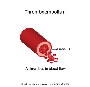 	
Thromboembolism. Circulating blood clot. Normal blood flow and a thrombus in blood flow, embolus. Red blood cells. Vector illustration.	
