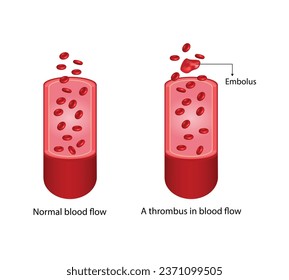 Thromboembolism. Circulating blood clot. Normal blood flow and a thrombus in blood flow, embolus. Red blood cell. Vector illustration.