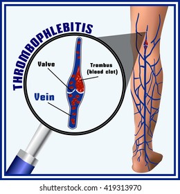 Thrombophlebitis Blood Clots Veins Embolism Thrombosis Stock Vector ...