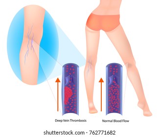 Thrombophlebitis. Deep Vein Thrombosis. Varicose Veins