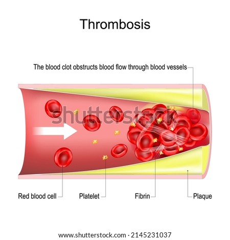 thrombosis. The clot obstructs blood flow through blood vessels. Cross section of blood vessel with atherosclerotic plaque, erythrocytes, Platelets and Fibrin. vector illustration