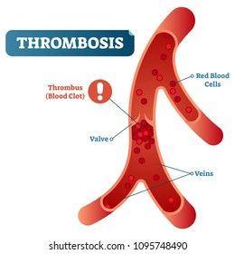 Thrombosis Medical Vector Illustration Cross Section Diagram, Unhealthy Blood Vessel Circulatory System Disease. Blocked Red Blood Cells Flow.