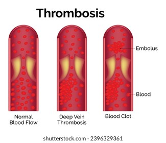 Ilustración del diseño del vector de diseño de la ciencia de la trombosis
