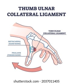 Thumb Ulnar Collateral Ligament As Finger Injury And Problem Outline Diagram. Labeled Educational Hand Xray With Bones And Cartilage After Medical Condition And Pain Explanation Vector Illustration.