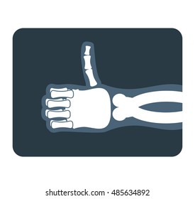 Thumbs up x-ray. Bones of hand shows all good. Medical illustration
