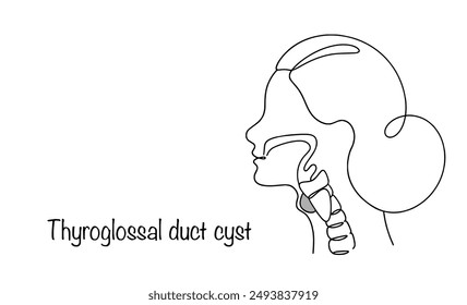 Thyroglossal Duct Cyst. A benign tumor of the neck located inferior to the thyroid gland and adjacent to the hyoid bone. Vector illustration.