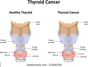 Thyroid Cancer