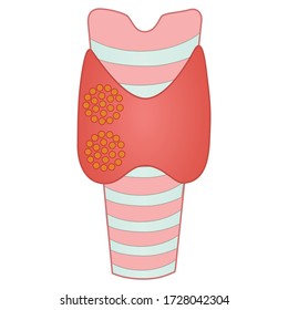 Thyroid cancer cell vector. A hand drawn illustration on isolated white background. Printable Eps 10 file format.