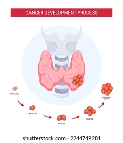 Thyroid cancer development process vector