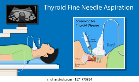 Thyroid cancer disease nodules ultrasound screening check medical treat fine needle aspiration lumps test lab gland neck pain Graves FNA FNAB Large Toxic diagnostic exam collect lymph nodes cell