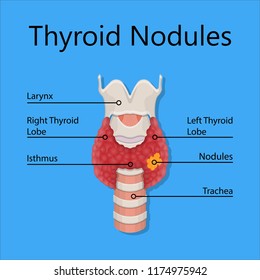 Thyroid cancer disease nodules ultrasound screening check medical treat fine needle aspiration lumps test lab gland neck pain Graves FNA FNAB Large Toxic diagnostic exam collect lymph nodes cell