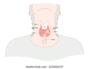 Thyroid cancer disease nodules ultrasound screening check medical treat fine needle aspiration lumps test lab gland neck pain Graves FNA FNAB Large Toxic diagnostic exam collect lymph nodes cell