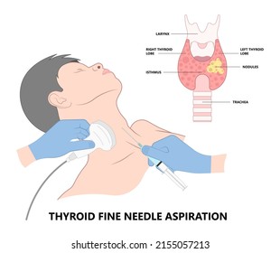 Thyroid cancer disease nodules ultrasound screening check medical treat fine needle aspiration lumps test lab gland neck pain Graves FNA FNAB Large Toxic diagnostic exam collect lymph nodes cell