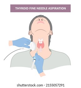 Thyroid cancer disease nodules ultrasound screening check medical treat fine needle aspiration lumps test lab gland neck pain Graves FNA FNAB Large Toxic diagnostic exam collect lymph nodes cell