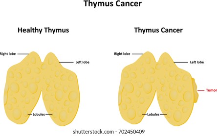 Thyroid Cancer Image