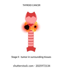 Thyroid cancer, second stage of tumor spreading. Thyroid gland, trachea and lymph nodes in female body. Inflammation and pain in human endocrine system. Internal organ exam flat vector illustration