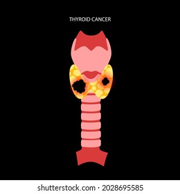 Thyroid Cancer Stage Anatomical Poster Thyroid Stock Vector (Royalty ...