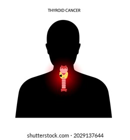 Thyroid Cancer Stage Male Body Thyroid Stock Vector (Royalty Free ...