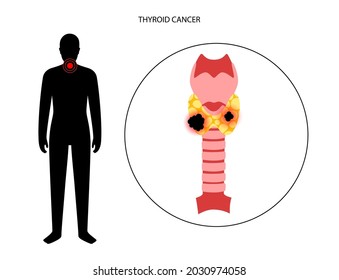Thyroid cancer stage in male body. Thyroid gland, trachea and lymph nodes concept. Neoplasm, inflammation, pain and tumor in the human endocrine system. Internal organs exam flat vector illustration.