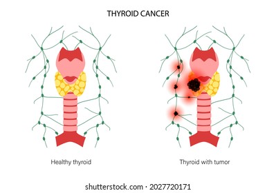 Thyroid cancer stages anatomical poster. Inflammation and pain in thyroid gland and healthy trachea. Neoplasm and tumor in the human endocrine system. Internal organs exam flat vector illustration.