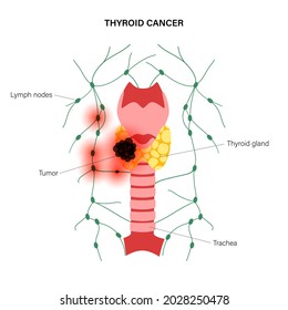 Thyroid cancer stages anatomical poster. Thyroid gland, trachea and lymph nodes in female body. Inflammation, pain, tumor in the human endocrine system. Internal organs exam flat vector illustration.