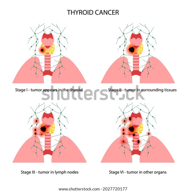 Thyroid Cancer Stages Anatomical Poster Thyroid Stock Vector (Royalty ...