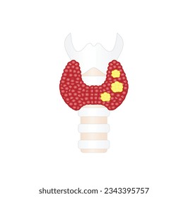 Thyroid cancer, unhealthy thyroid with Inflammation and lump. Vector illustration isolated on white background.