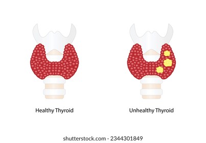 Thyroid cancer, unhealthy thyroid with Inflammation and lump. Vector illustration isolated on white background.