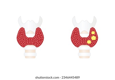 Thyroid cancer, unhealthy thyroid with Inflammation and lump. Vector illustration isolated on white background.