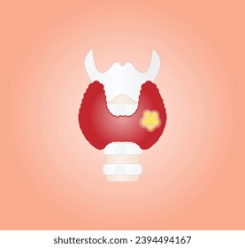 Thyroid cancer, unhealthy thyroid with Inflammation and lump. Vector illustration isolated on white background.