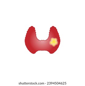 Thyroid cancer, unhealthy thyroid with Inflammation and lump. Vector illustration isolated on white background.