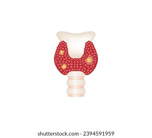 Thyroid cancer, unhealthy thyroid with Inflammation and lump. Vector illustration isolated on white background.