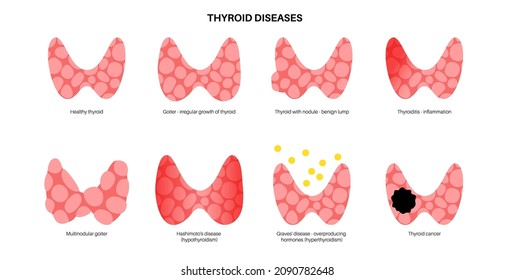 Thyroid Gland Diseases Endocrinology Clinic Concept Stock Vector ...