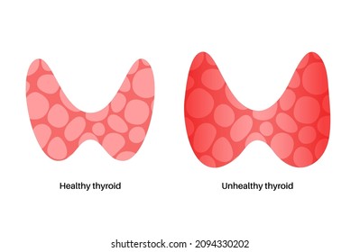 Thyroid Gland Diseases Endocrinology Clinic Concept Stock Vector ...