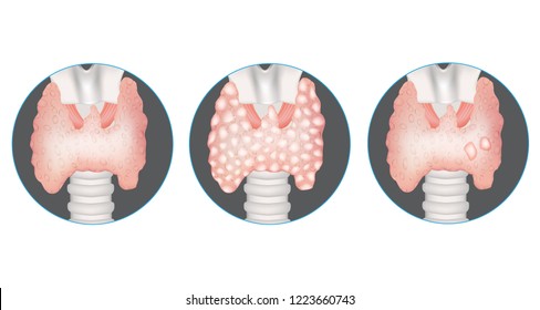 Thyroid gland diseases. Healthy thyroid, multinodular goiter and gland with nodules. 