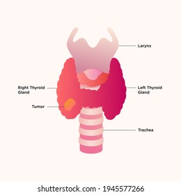 Thyroid Gland And Larynx Diagram. Thyroid Cancer. Thyroid Gland Medical Concept As A Human Organ With Trachea And Larynx As A Symbol For Endocrinology System