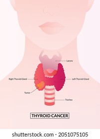 Thyroid Gland And Larynx Diagram. Thyroid Cancer. Thyroid Gland Medical Concept As A Human Organ With Trachea And Larynx.