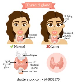 Thyroid gland. Medical concept. Anatomy of people. Vector illustration. Health care banner with woman. 
