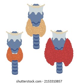  thyroid gland in three states is isolated on a white background. Image of Hypothyroidism, disease for Medical centers, education. World Thyroid Day