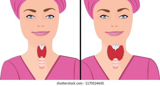 Thyroid healthy and enlarged thyroid. hypothyroid vector illustration on a white background