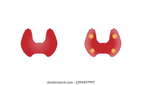 Glándula tiroidea y paratiroidea. Anatomía frontal y posterior de la glándula tiroidea. hipotiroidismo vs hipertiroidismo. Ilustración vectorial aislada en fondo blanco.